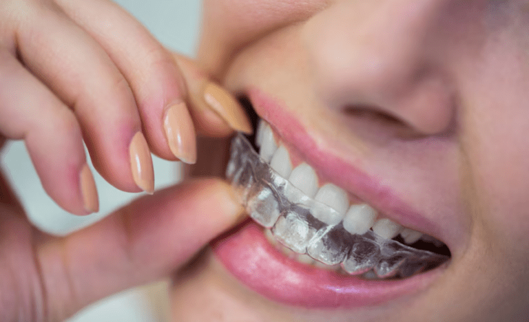 Discover the Best Invisalign Options in London, Ontario for Your Perfect Smile