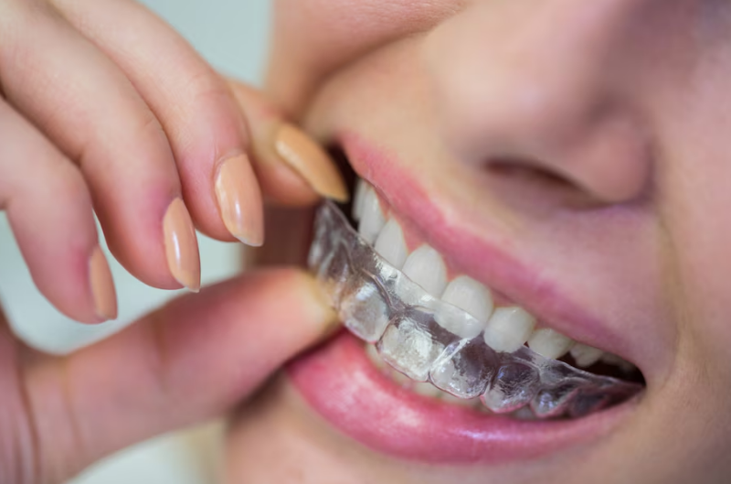 Discover the Best Invisalign Options in London, Ontario for Your Perfect Smile