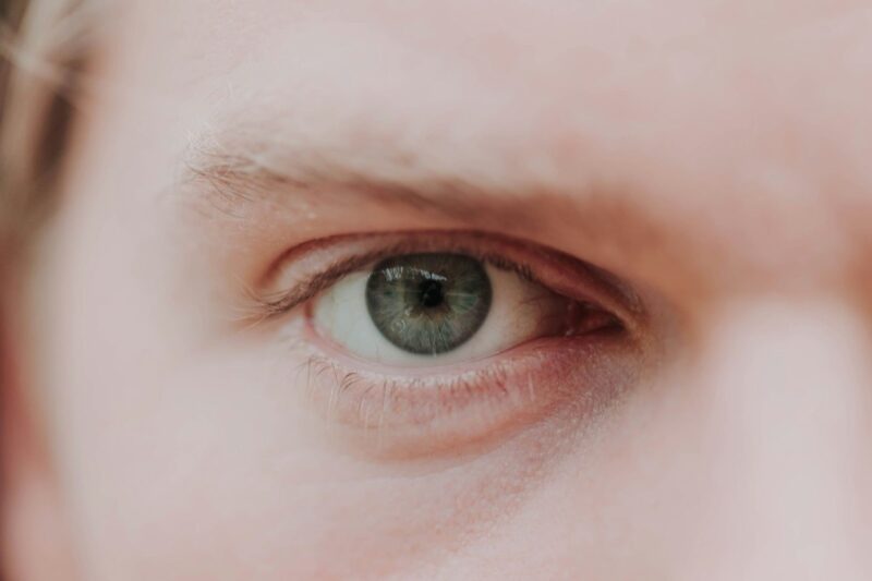 Understanding “Coke Eyes”: What Are They?