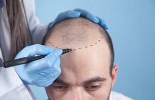 Hair Transplant in Dubai