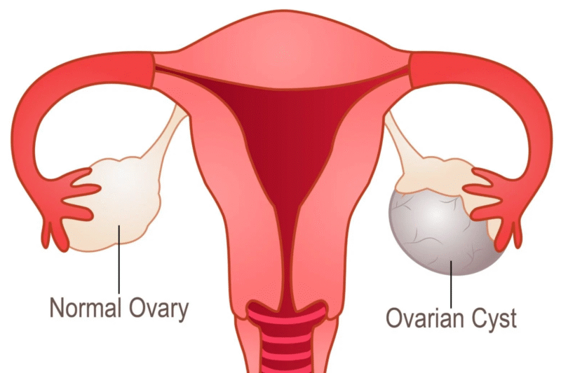 Myths vs. Facts: What Every Woman Should Know About Ovarian Health